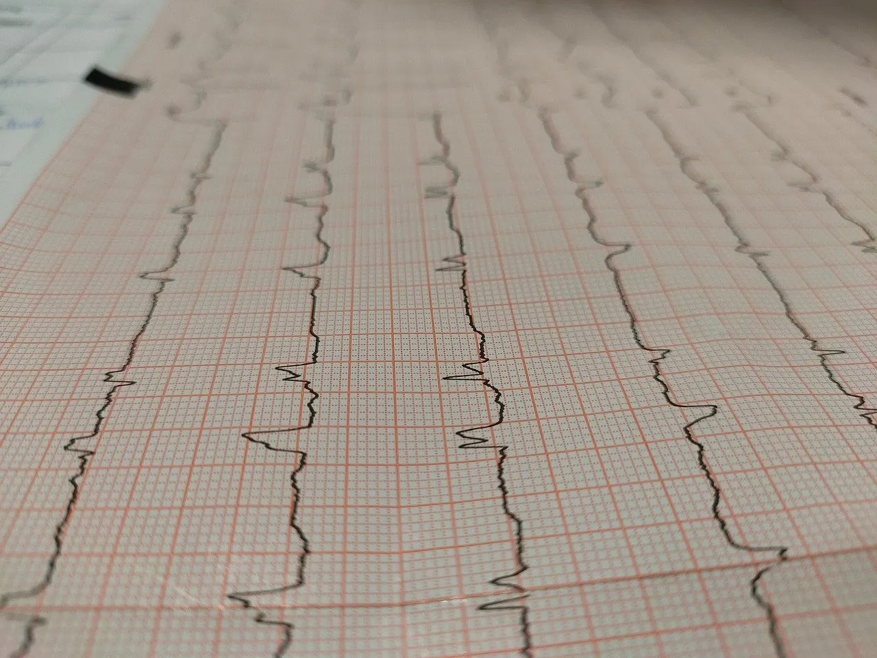 Ausgedruckter EKG-Streifen auf rot kariertem Millimeterpapier mit mehreren schwarzen Herzstromkurven, schräg von oben fotografiert